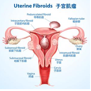 香港验血最快几周可以验男女,子宫肌瘤做试管婴儿能成功吗？